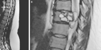 A Woman Had Strange Feelings in Her Legs. Doctors Found Parasites in Her Spine