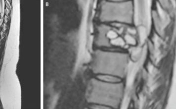 A Woman Had Strange Feelings in Her Legs. Doctors Found Parasites in Her Spine