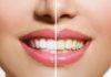 Why Do Human Teeth Turn Yellow?