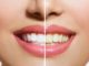 Why Do Human Teeth Turn Yellow?