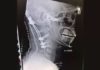 22-Year-Old Survives Rare ‘Internal Decapitation’ Injury from Crash. He Previously Beat Brain Cancer.
