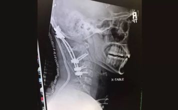 22-Year-Old Survives Rare ‘Internal Decapitation’ Injury from Crash. He Previously Beat Brain Cancer.