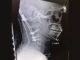 22-Year-Old Survives Rare ‘Internal Decapitation’ Injury from Crash. He Previously Beat Brain Cancer.