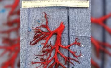 Human Coughs Up a Giant Blood Clot in the Shape of His Lung