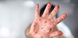 Measles outbreak linked to Thailand