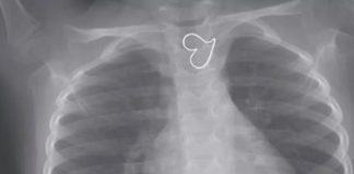 Here’s Why a Perfect Heart Shape Showed Up on a Girl’s X-Ray