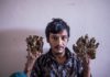 Bangladesh ‘Tree Man’ wants hands amputated to relieve pain