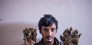 Bangladesh ‘Tree Man’ wants hands amputated to relieve pain