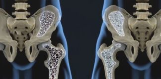Osteoporosis: Risks, Symptoms and Treatment