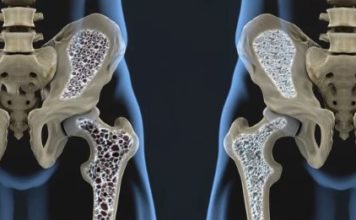 Osteoporosis: Risks, Symptoms and Treatment