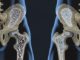 Osteoporosis: Risks, Symptoms and Treatment Osteoporosis: Risks, Symptoms and Treatment