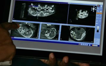 Indian boy, seven, found with 526 teeth inside his mouth